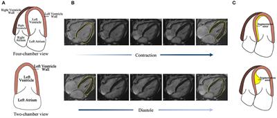 A Dense RNN for Sequential Four-Chamber View Left Ventricle Wall Segmentation and Cardiac State Estimation